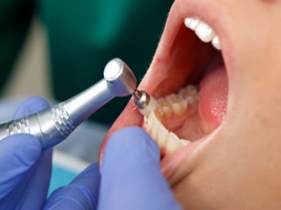 What Happens During a Schaumburg Dental Studio Cleaning?