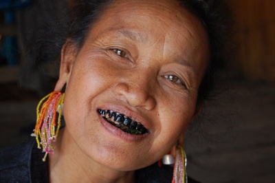 ann-woman-black-teeth