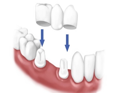 Why You Should Know About The Different Kinds of Dental Crowns