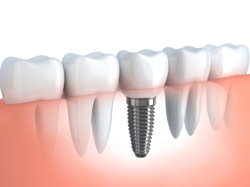 How Dental Implants Succeed