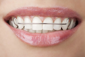 How Long Should I Wear a Retainer?