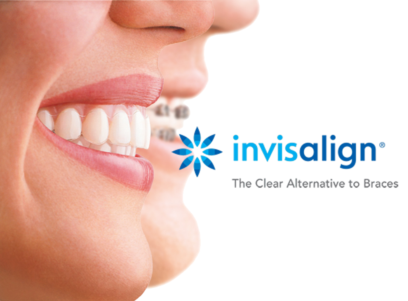 Smile Wide With Invisalign