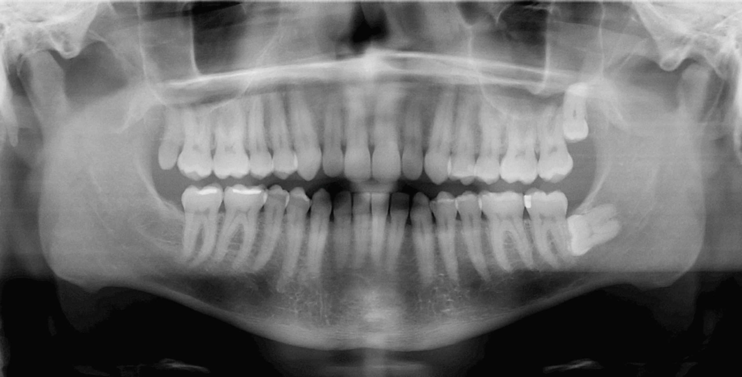 impacted wisdom tooth extraction - Schaumburg, IL