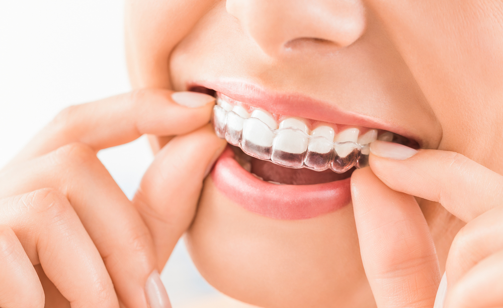 Invisalign – Straightening Your Teeth Is Good for Your Health