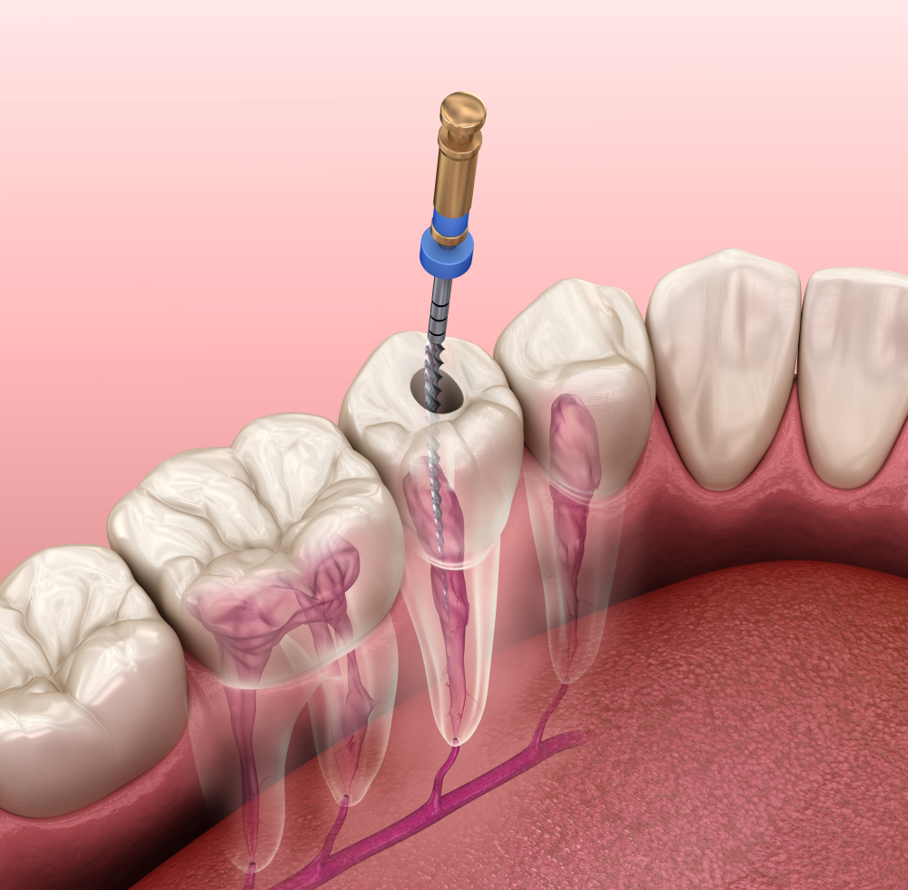 Changing the Reputation of Root Canals