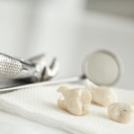 Wisdom Teeth Extraction and Dry Sockets