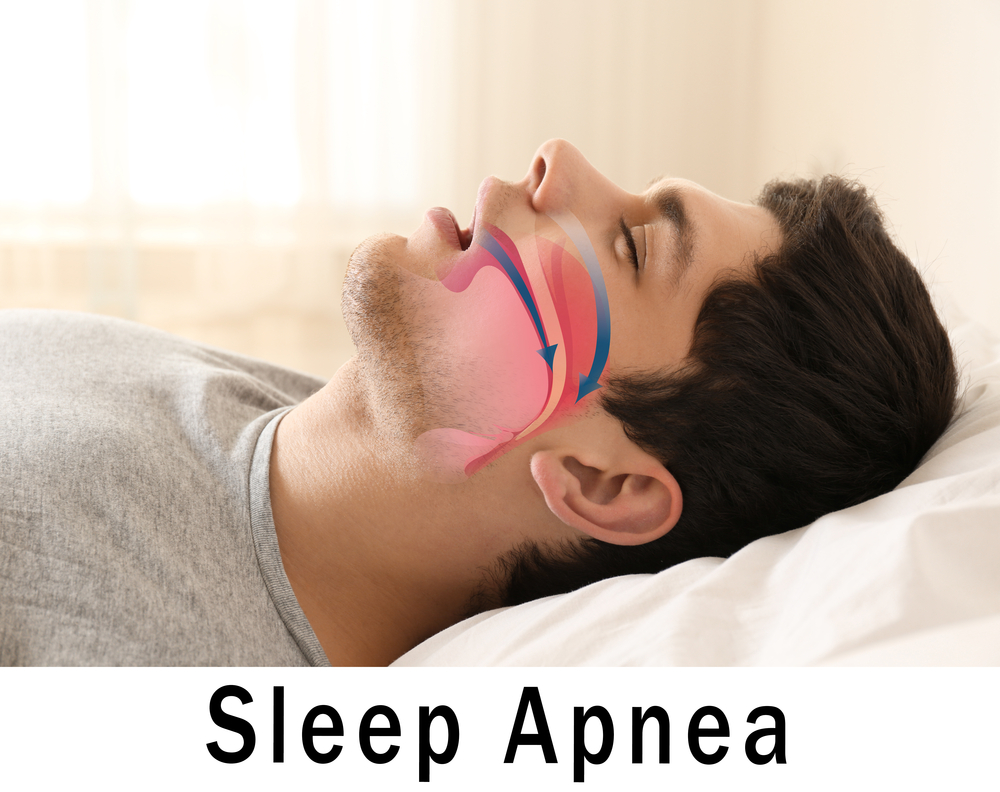 Sleep Apnea: The Symptoms and Fix