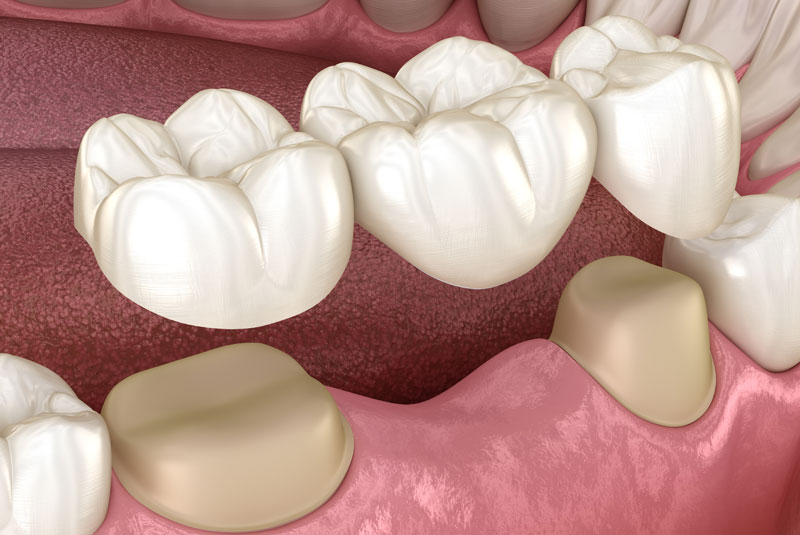 Is It Better to Get a Dental Bridge or Dental implants?