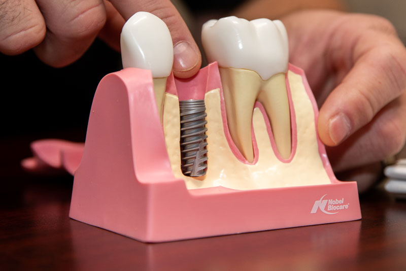 A Brief Guide to Dental Implant Surgery