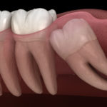 Has your Dentist suggested that you have your wisdom teeth removed?