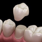 CEREC Crowns: A Quick Fix When You Need It Most