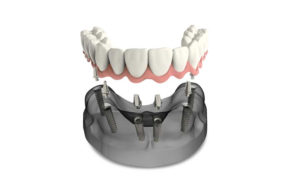 Get your Smile back with Implant Supported Dentures