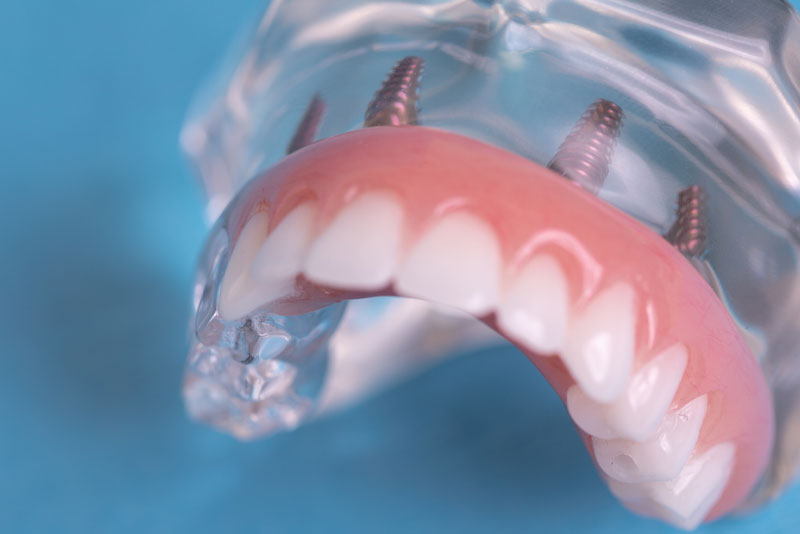 Advantages of Full-Arch Dental Implants vs. Dentures