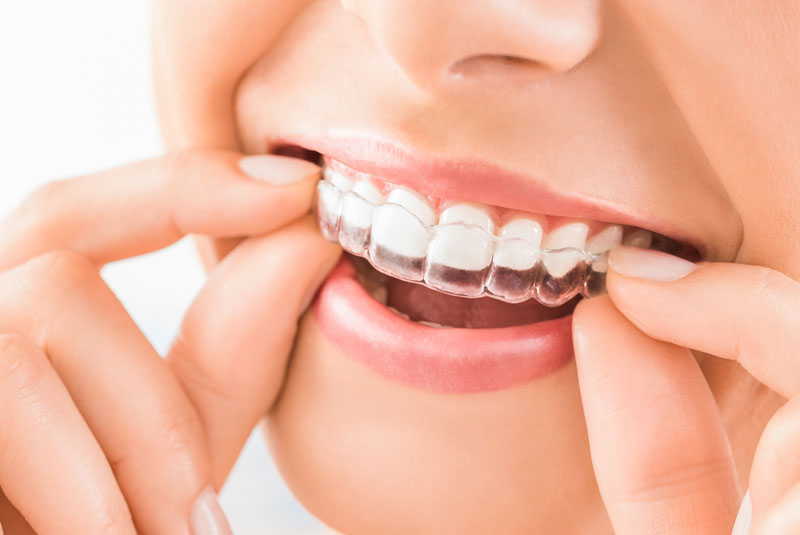 Invisalign®: The Most Discreet Way to Straighten Teeth