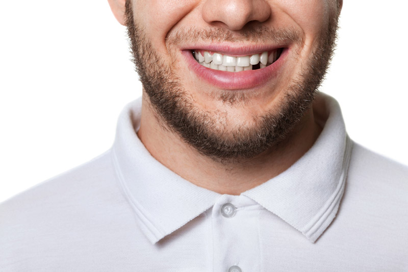 5 Reasons You Need to Replace Missing Teeth