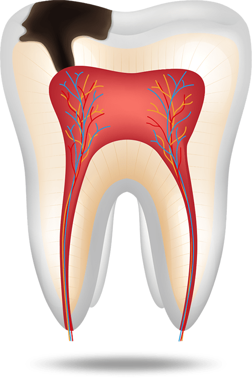 tooth cavity graphic