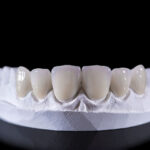 Unveiling the Aesthetics and Practicality of Metal Crowns on Front Teeth